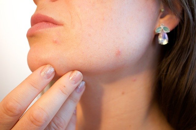 What Is an Acne Treatment Facial?